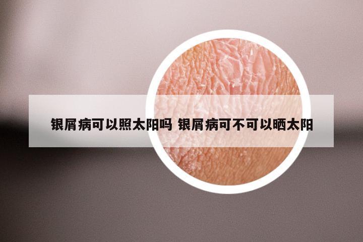 银屑病可以照太阳吗 银屑病可不可以晒太阳