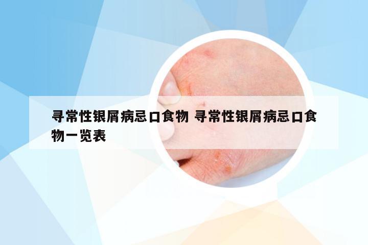 寻常性银屑病忌口食物 寻常性银屑病忌口食物一览表