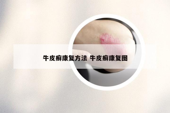 牛皮癣康复方法 牛皮癣康复图