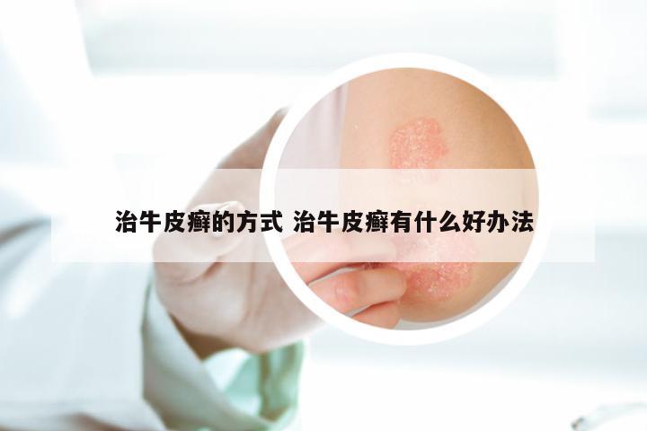 治牛皮癣的方式 治牛皮癣有什么好办法