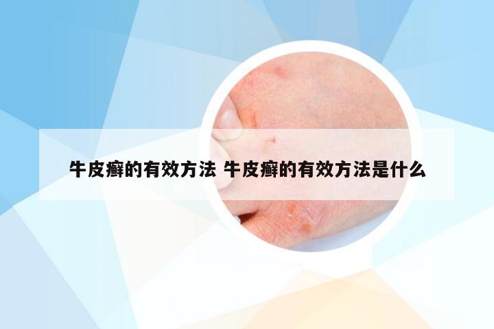 牛皮癣的有效方法 牛皮癣的有效方法是什么
