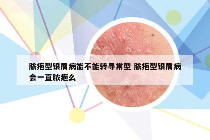 脓疱型银屑病能不能转寻常型 脓疱型银屑病会一直脓疱么