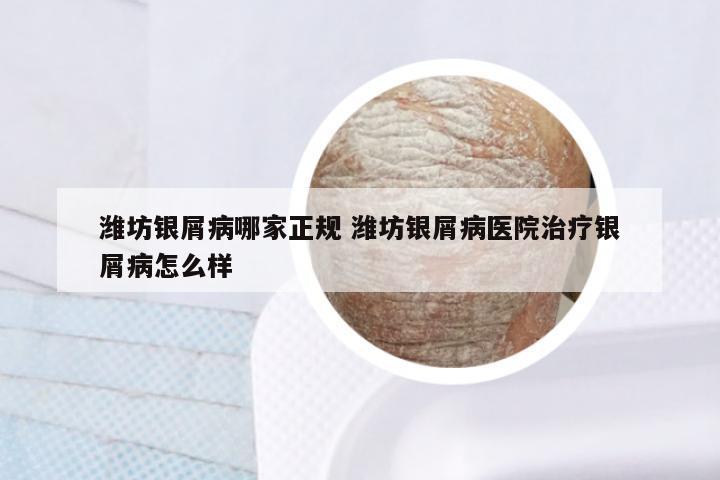 潍坊银屑病哪家正规 潍坊银屑病医院治疗银屑病怎么样