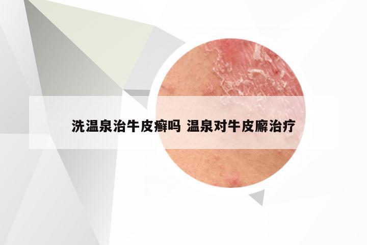 洗温泉治牛皮癣吗 温泉对牛皮廨治疗