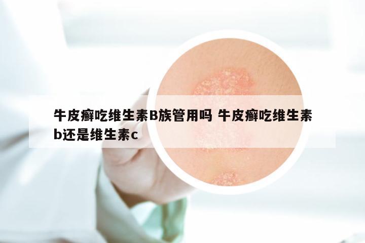 牛皮癣吃维生素B族管用吗 牛皮癣吃维生素b还是维生素c