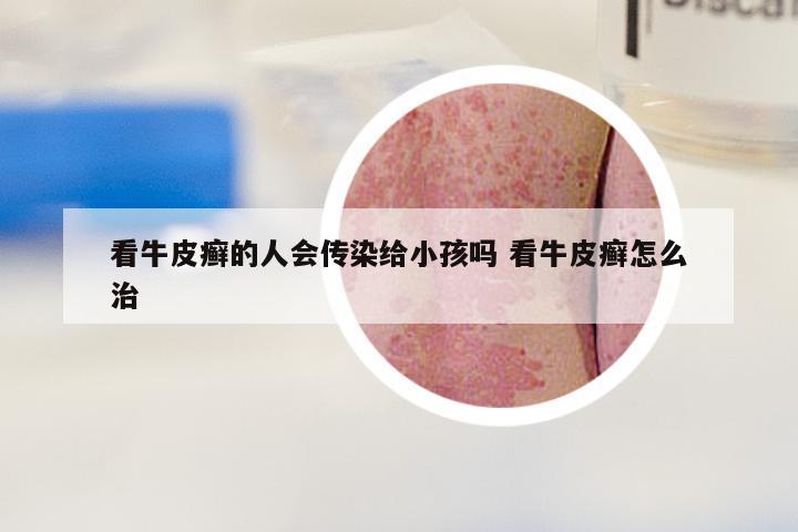 看牛皮癣的人会传染给小孩吗 看牛皮癣怎么治