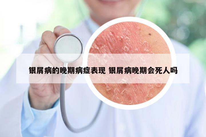 银屑病的晚期病症表现 银屑病晚期会死人吗
