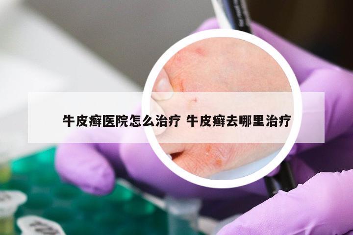 牛皮癣医院怎么治疗 牛皮癣去哪里治疗