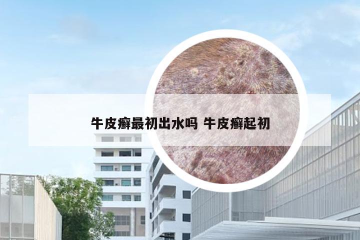 牛皮癣最初出水吗 牛皮癣起初