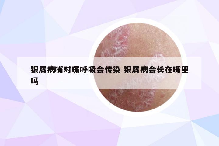 银屑病嘴对嘴呼吸会传染 银屑病会长在嘴里吗