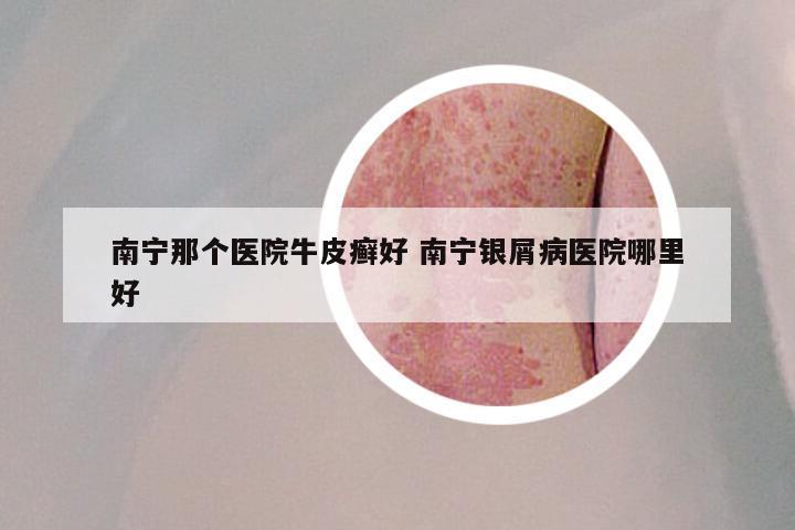 南宁那个医院牛皮癣好 南宁银屑病医院哪里好