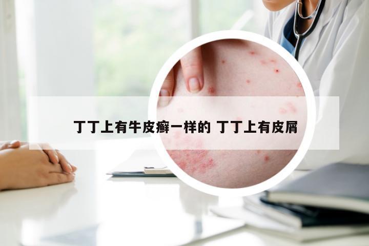 丁丁上有牛皮癣一样的 丁丁上有皮屑