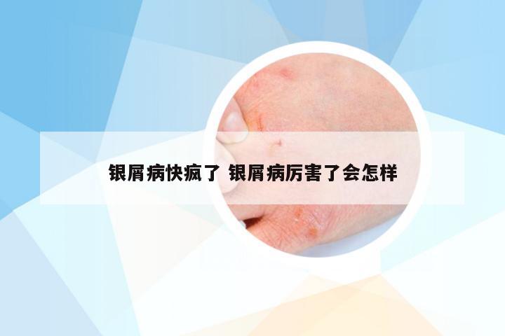 银屑病快疯了 银屑病厉害了会怎样
