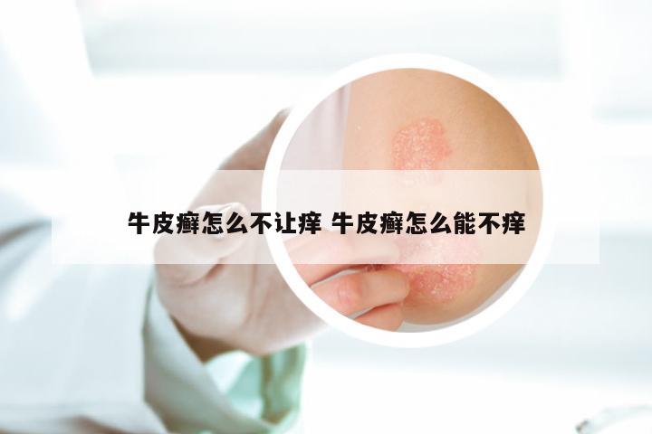 牛皮癣怎么不让痒 牛皮癣怎么能不痒