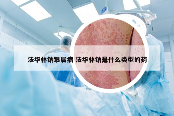 法华林钠银屑病 法华林钠是什么类型的药