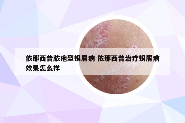 依那西普脓疱型银屑病 依那西普治疗银屑病效果怎么样