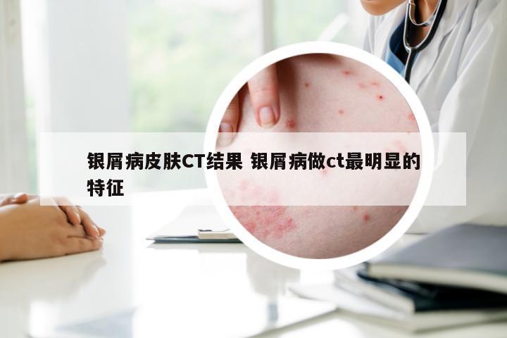 银屑病皮肤CT结果 银屑病做ct最明显的特征