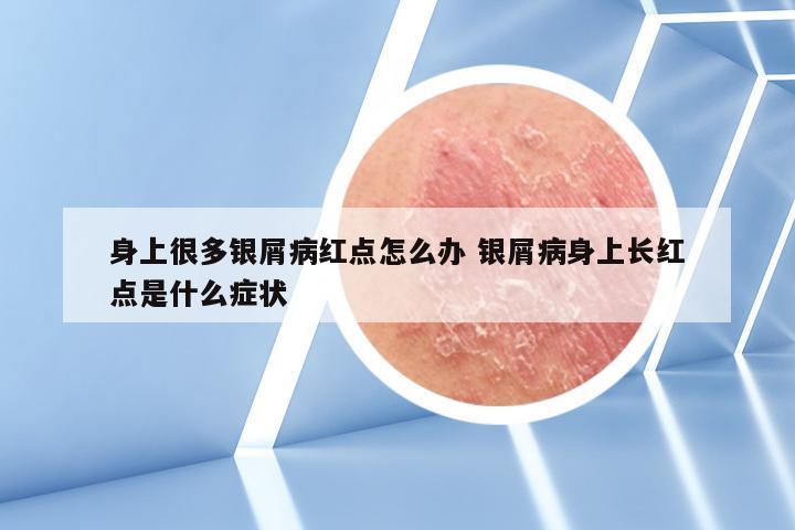 身上很多银屑病红点怎么办 银屑病身上长红点是什么症状