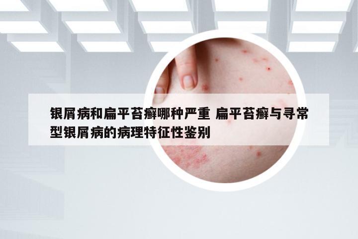 银屑病和扁平苔癣哪种严重 扁平苔癣与寻常型银屑病的病理特征性鉴别