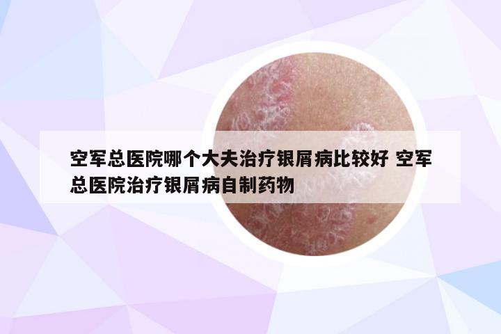 空军总医院哪个大夫治疗银屑病比较好 空军总医院治疗银屑病自制药物