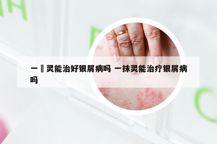 一抺灵能治好银屑病吗 一抹灵能治疗银屑病吗