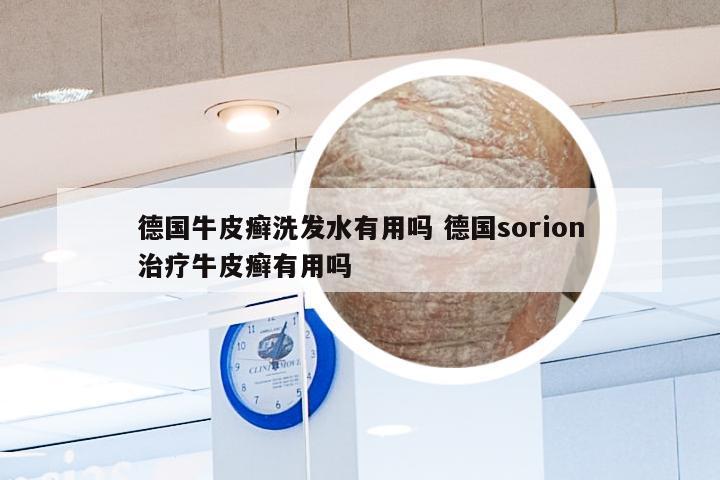 德国牛皮癣洗发水有用吗 德国sorion治疗牛皮癣有用吗