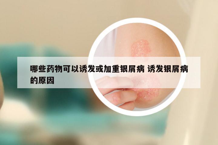 哪些药物可以诱发或加重银屑病 诱发银屑病的原因