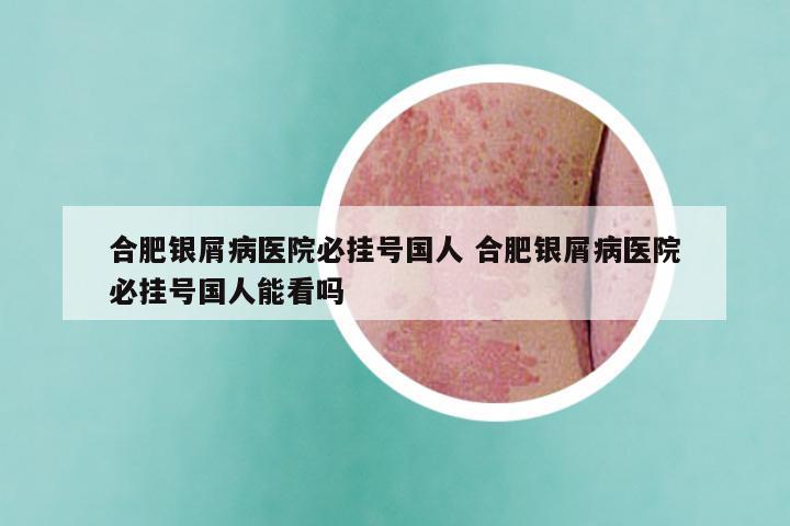 合肥银屑病医院必挂号国人 合肥银屑病医院必挂号国人能看吗
