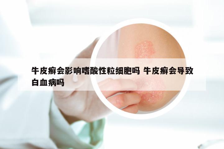 牛皮癣会影响嗜酸性粒细胞吗 牛皮癣会导致白血病吗