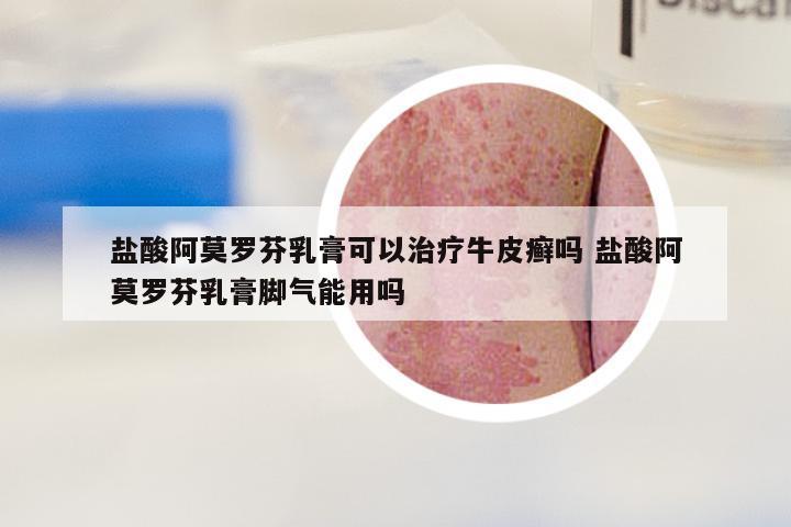 盐酸阿莫罗芬乳膏可以治疗牛皮癣吗 盐酸阿莫罗芬乳膏脚气能用吗