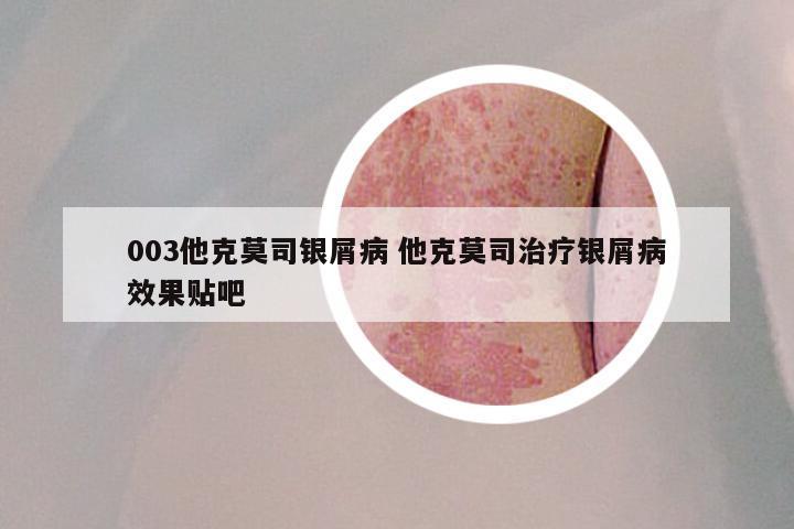 003他克莫司银屑病 他克莫司治疗银屑病效果贴吧