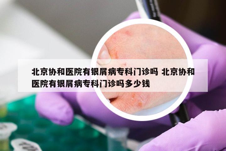 北京协和医院有银屑病专科门诊吗 北京协和医院有银屑病专科门诊吗多少钱