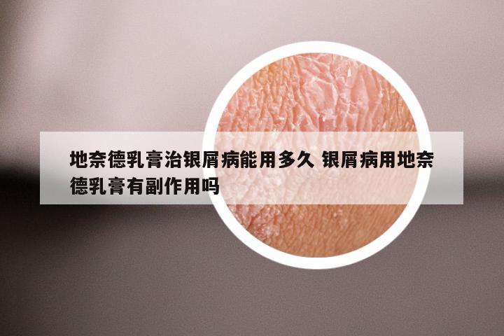 地奈德乳膏治银屑病能用多久 银屑病用地奈德乳膏有副作用吗