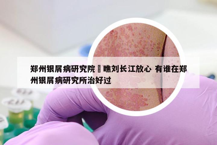 郑州银屑病研究院來瞧刘长江放心 有谁在郑州银屑病研究所治好过