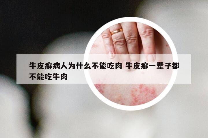 牛皮癣病人为什么不能吃肉 牛皮癣一辈子都不能吃牛肉
