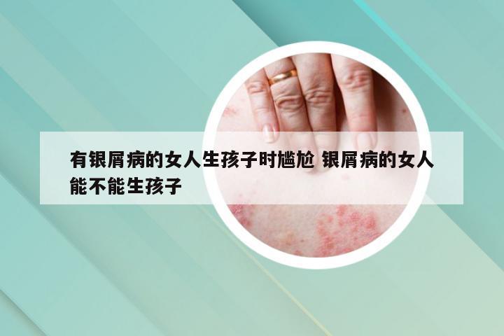 有银屑病的女人生孩子时尴尬 银屑病的女人能不能生孩子