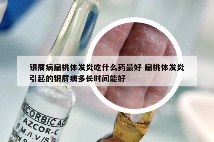 银屑病扁桃体发炎吃什么药最好 扁桃体发炎引起的银屑病多长时间能好