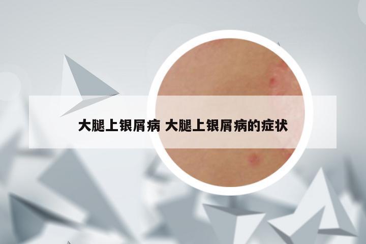 大腿上银屑病 大腿上银屑病的症状