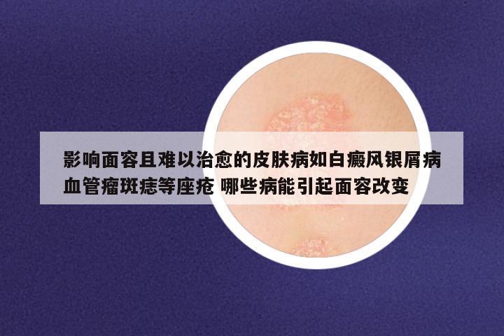 影响面容且难以治愈的皮肤病如白癜风银屑病血管瘤斑痣等座疮 哪些病能引起面容改变