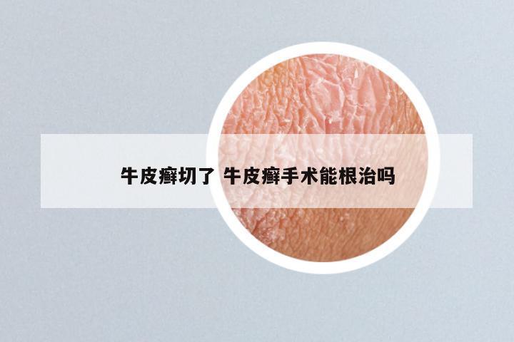 牛皮癣切了 牛皮癣手术能根治吗