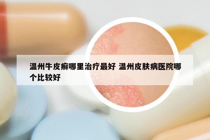 温州牛皮癣哪里治疗最好 温州皮肤病医院哪个比较好