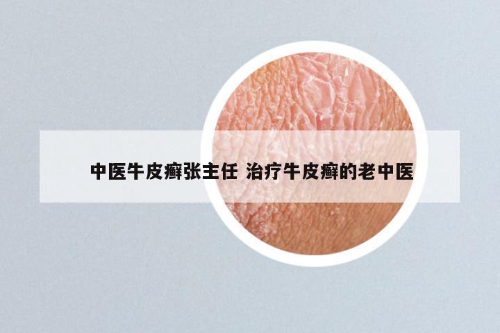 中医牛皮癣张主任 治疗牛皮癣的老中医