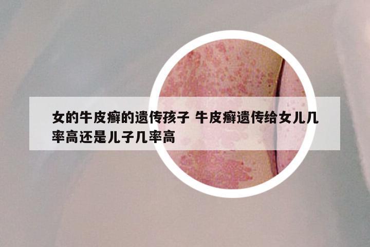 女的牛皮癣的遗传孩子 牛皮癣遗传给女儿几率高还是儿子几率高
