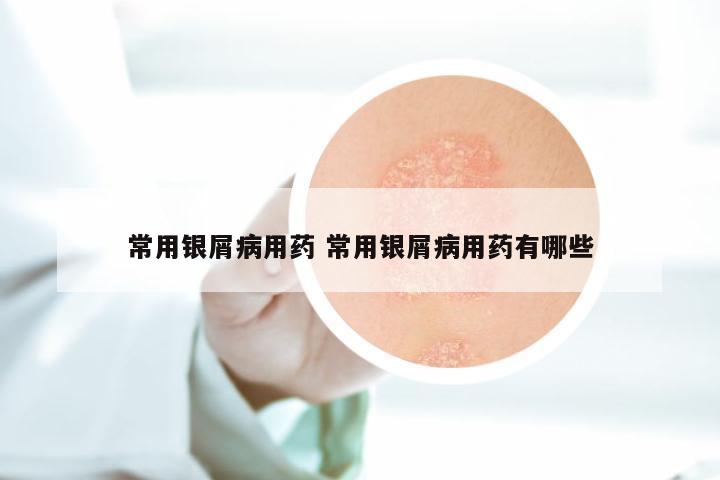 常用银屑病用药 常用银屑病用药有哪些