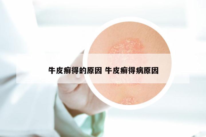 牛皮癣得的原因 牛皮癣得病原因