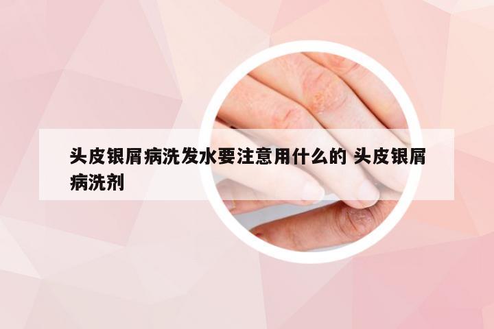 头皮银屑病洗发水要注意用什么的 头皮银屑病洗剂
