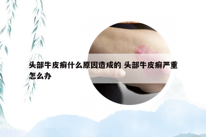 头部牛皮癣什么原因造成的 头部牛皮癣严重怎么办