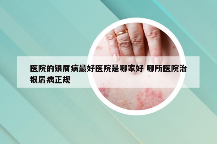 医院的银屑病最好医院是哪家好 哪所医院治银屑病正规