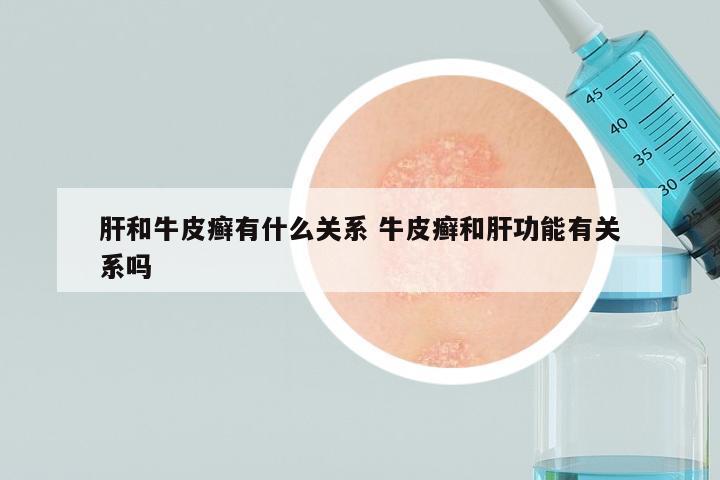 肝和牛皮癣有什么关系 牛皮癣和肝功能有关系吗