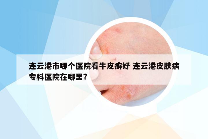 连云港市哪个医院看牛皮癣好 连云港皮肤病专科医院在哪里?